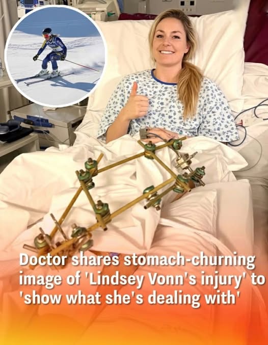 Renowned Doctor Reveals Graphic Image of the Same Devastating Injury Lindsey Vonn Endured