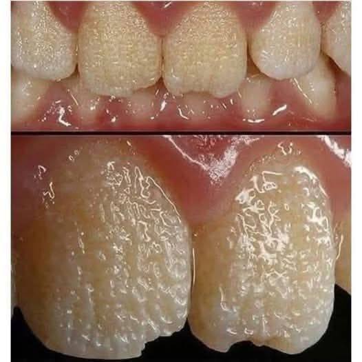 Be Careful! This Is What Can Happen to Your Teeth When You Eat Certain Everyday Foods and Drinks
